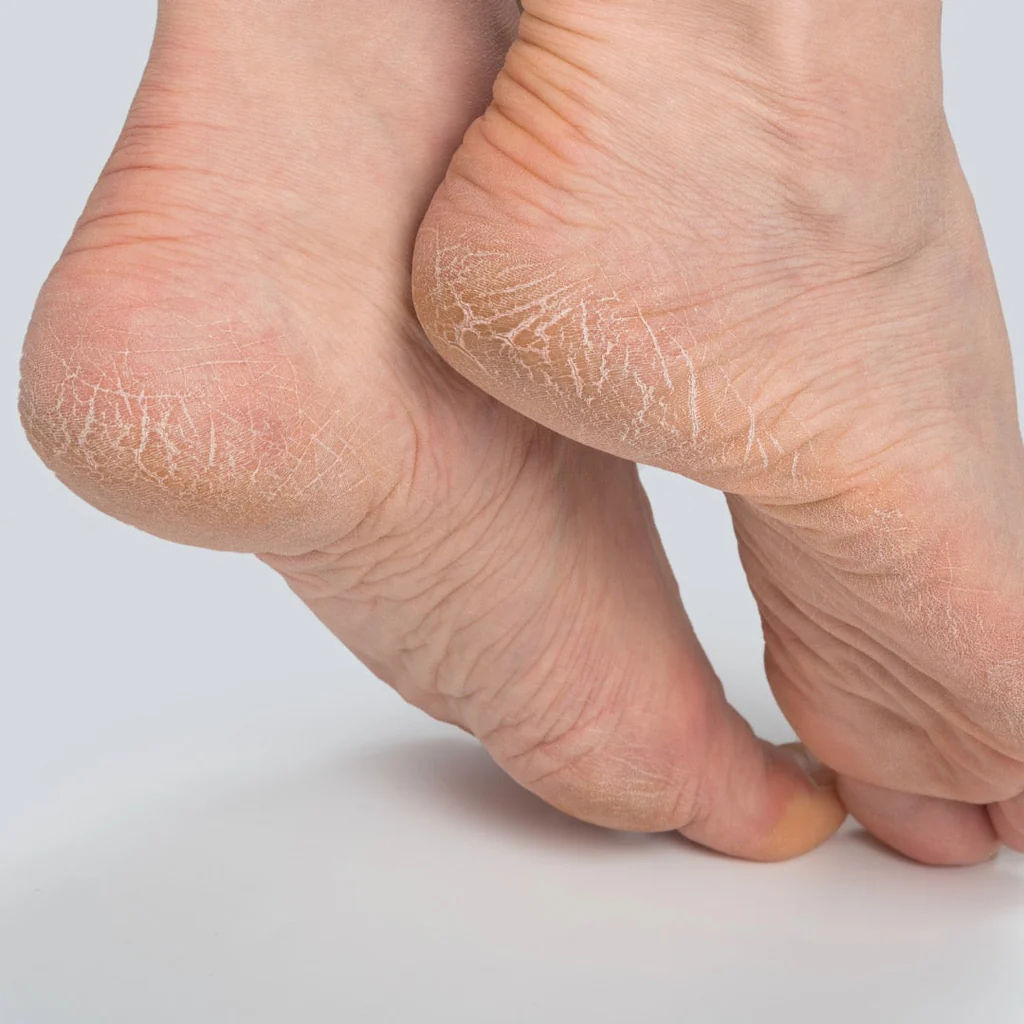 Cracked Heels, Chapped Lips & Winter Skin Infections: An Ayurvedic View“