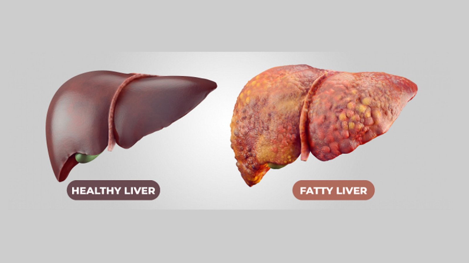 The Growing Rise of Fatty Liver, Poor Digestion & Liver Toxicity in Modern Lifestyles