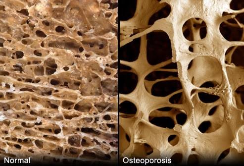 Osteoporosis and Age-Related Bone Weakness: A Growing Risk in Modern Lifestyles